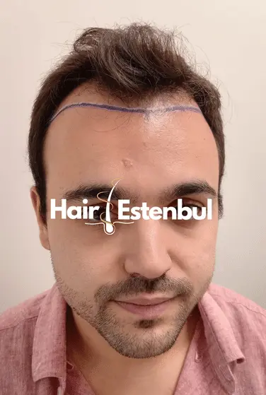 Hair Transplant Turkey Before and After