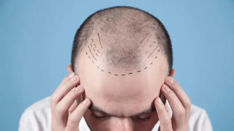 Reasons for Hair Transplantation and Who is a Suitable Candidate